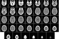 Новое исследование может изменить способ лечения сотрясения мозга