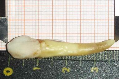 Стоматолог удалил пациенту самый длинный в истории зуб